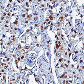 KAP1 was detected in immersion fixed paraffin-embedded sections of human liver cancer tissue using Mouse Anti-Human KAP1 Monoclonal Antibody (Catalog # MAB7785) at 0.5 µg/mL for 1 hour at room temperature followed by incubation with the Anti-Mouse IgG VisUCyte™ HRP Polymer Antibody (VC001). Tissue was stained using DAB (brown) and counterstained with hematoxylin (blue). Specific staining was localized to nuclei. View our protocol for IHC Staining with VisUCyte HRP Polymer Detection Reagents.