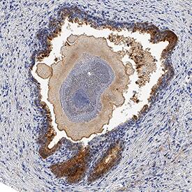 Kallikrein 3/PSA was detected in immersion fixed paraffin-embedded sections of human prostate using Mouse Anti-Human Kallikrein 3/PSA Monoclonal Antibody (Catalog # MAB13443) at 5 µg/mL for 1 hour at room temperature followed by incubation with the Anti-Mouse IgG VisUCyte™ HRP Polymer Antibody (Catalog # VC001). Tissue was stained using DAB (brown) and counterstained with hematoxylin (blue). Specific staining was localized to cytoplasm in epithelial cells. View our protocol for IHC Staining with VisUCyte HRP Polymer Detection Reagents.