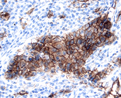 Kallikrein 6/Neurosin was detected in immersion fixed paraffin-embedded sections of human breast cancer tissue using 15 &micro;g/mL Goat Anti-Human Kallikrein 6/Neurosin Antigen Affinity-purified Polyclonal Antibody (Catalog # AF2008) overnight at 4 &deg;C. Tissue was stained with the Anti-Goat HRP-DAB Cell & Tissue Staining Kit (brown; Catalog # CTS008) and counterstained with hematoxylin (blue). View our protocol for Chromogenic IHC Staining of Paraffin-embedded Tissue Sections.