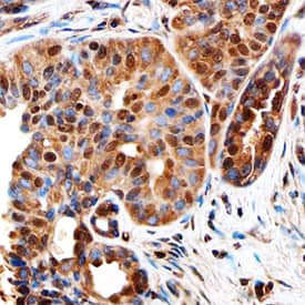 Ki67/MKI67 was detected in immersion fixed paraffin-embedded sections of human breast cancer tissue using Sheep Anti-Human Ki67/MKI67 Antigen Affinity-purified Polyclonal Antibody (Catalog # AF7617) at 1 µg/mL overnight at 4 °C. Before incubation with the primary antibody, tissue was subjected to heat-induced epitope retrieval using Antigen Retrieval Reagent-Basic (CTS013). Tissue was stained using the Anti-Sheep HRP-DAB Cell & Tissue Staining Kit (brown; Catalog # CTS019) and counterstained with hematoxylin (blue). Specific staining was localized to the nuclei of epithelial cells. View our protocol for Chromogenic IHC Staining of Paraffin-embedded Tissue Sections.