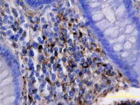 Kremen-1 was detected in immersion fixed paraffin-embedded sections of human colon cancer tissue using Goat Anti-Human Kremen-1 Antigen Affinity-purified Polyclonal Antibody (Catalog # AF2127) at 15 µg/mL overnight at 4 °C. Tissue was stained using the Anti-Goat HRP-DAB Cell & Tissue Staining Kit (brown; Catalog # CTS008) and counterstained with hematoxylin (blue). View our protocol for Chromogenic IHC Staining of Paraffin-embedded Tissue Sections.