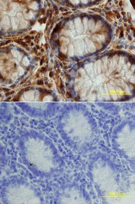 Kremen-1 was detected in immersion fixed paraffin-embedded sections of human colon array using Goat Anti-Human Kremen-1 Antigen Affinity-purified Polyclonal Antibody (Catalog # AF2127) at 15 µg/mL overnight at 4 °C. Tissue was stained using the Anti-Goat HRP-DAB Cell & Tissue Staining Kit (brown; Catalog # CTS008) and counterstained with hematoxylin (blue). Lower panel shows a lack of labeling if primary antibodies are omitted and tissue is stained only with secondary antibody followed by incubation with detection reagents. View our protocol for Chromogenic IHC Staining of Paraffin-embedded Tissue Sections.