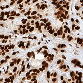 Ku80/XRCC5 was detected in immersion fixed paraffin-embedded sections of human breast cancer tissue using Goat Anti-Human Ku80/XRCC5 Antigen Affinity-purified Polyclonal Antibody (Catalog # AF5619) at 1 µg/mL for 1 hour at room temperature followed by incubation with the Anti-Goat IgG VisUCyte™ HRP Polymer Antibody (Catalog # VC004). Tissue was stained using DAB (brown) and counterstained with hematoxylin (blue). Specific staining was localized to nuclei. View our protocol for IHC Staining with VisUCyte HRP Polymer Detection Reagents.