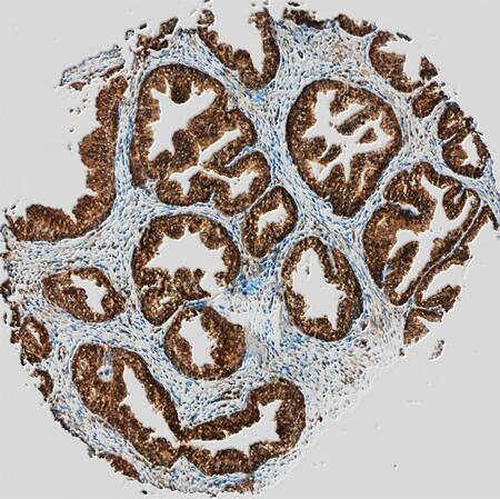 LAP (TGF-beta 1) was detected in immersion fixed paraffin-embedded sections of human prostate cancer tissue using Goat Anti-Human LAP (TGF-beta 1) Antigen Affinity-purified Polyclonal Antibody (Catalog # AF-246-NA) at 10 µg/mL overnight at 4 °C. Tissue was stained using the Anti-Goat HRP-DAB Cell & Tissue Staining Kit (brown; Catalog # CTS008) and counterstained with hematoxylin (blue). Specific staining was localized to cytoplasm in epithelial cells. View our protocol for Chromogenic IHC Staining of Paraffin-embedded Tissue Sections.