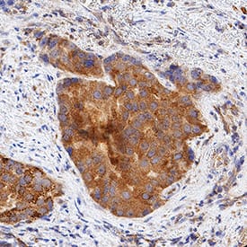 LPAR1/LPA1/EDG-2 was detected in immersion fixed paraffin-embedded sections of human prostate cancer tissue using Mouse Anti-Human LPAR1/LPA1/EDG-2 Monoclonal Antibody (Catalog # MAB9963) at 5 µg/mL for 1 hour at room temperature followed by incubation with the Anti-Mouse IgG VisUCyte™ HRP Polymer Antibody (Catalog # VC001). Before incubation with the primary antibody, tissue was subjected to heat-induced epitope retrieval using Antigen Retrieval Reagent-Basic (Catalog # CTS013). Tissue was stained using DAB (brown) and counterstained with hematoxylin (blue). Specific staining was localized to cell surfaces and cytoplasm in cancer cells. View our protocol for IHC Staining with VisUCyte HRP Polymer Detection Reagents.