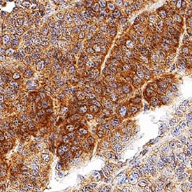 LRIG2 was detected in immersion fixed paraffin-embedded sections of human squamous cell carcinoma using Mouse Anti-Human LRIG2 Monoclonal Antibody (Catalog # MAB19411) at 5 µg/mL for 1 hour at room temperature followed by incubation with the Anti-Mouse IgG VisUCyte™ HRP Polymer Antibody (Catalog # VC001). Tissue was stained using DAB (brown) and counterstained with hematoxylin (blue). Specific staining was localized to cytoplasm. View our protocol for IHC Staining with VisUCyte HRP Polymer Detection Reagents.