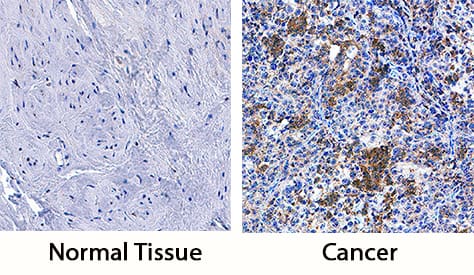 LRIG3 was detected in immersion fixed paraffin-embedded sections of human cervical cancer tissue using Goat Anti-Human LRIG3 Antigen Affinity-purified Polyclonal Antibody (Catalog # AF3495) at 3 µg/mL overnight at 4 °C. Tissue was stained using the Anti-Goat HRP-DAB Cell & Tissue Staining Kit (brown; Catalog # CTS008) and counterstained with hematoxylin (blue). Specific staining was localized to cytoplasm of cancer cells. View our protocol for Chromogenic IHC Staining of Paraffin-embedded Tissue Sections.