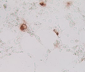 Lgr5/GPR49 was detected in MYC tagged human transfectants using Mouse Anti-Human Lgr5/GPR49 Monoclonal Antibody (Catalog # MAB8078). Cells were stained using an anti-mouse HRP-conjugated secondary antibody (brown). Specific staining was localized to cytoplasm.Image courtesy of Dr. Hans Clevers, Hubrecht Institute, The Netherlands.
