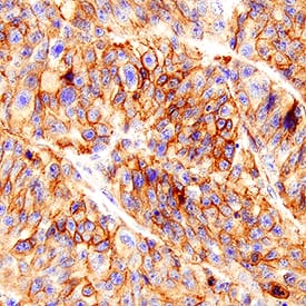 MCAM/CD146 was detected in immersion fixed paraffin-embedded sections of human melanoma tissue using Goat Anti-Human MCAM/CD146 Antigen Affinity-purified Polyclonal Antibody (Catalog # AF932) at 3 µg/mL for 1 hour at room temperature followed by incubation with the Anti-Goat IgG VisUCyte™ HRP Polymer Antibody (Catalog # VC004). Tissue was stained using DAB (brown) and counterstained with hematoxylin (blue). Specific staining was localized to plasma membrane in cancer cells. View our protocol for IHC Staining with VisUCyte HRP Polymer Detection Reagents.