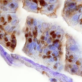 MELK was detected in immersion fixed paraffin-embedded sections of human breast cancer tissue using Sheep Anti-Human MELK Antigen Affinity-purified Polyclonal Antibody (Catalog # AF4820) at 10 µg/mL overnight at 4 °C. Tissue was stained using the Anti-Sheep HRP-DAB Cell & Tissue Staining Kit (brown; Catalog # CTS019) and counterstained with hematoxylin (blue). Specific staining was localized to plasma membranes of glandular epithelial cells. View our protocol for Chromogenic IHC Staining of Paraffin-embedded Tissue Sections.