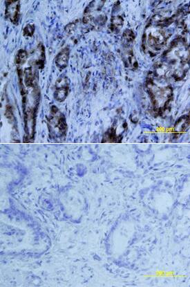 MIA was detected in immersion fixed paraffin-embedded sections of human pancreas array using Mouse Anti-Human MIA Monoclonal Antibody (Catalog # MAB20501) at 25 µg/mL overnight at 4 °C. Tissue was stained using the Anti-Mouse HRP-DAB Cell & Tissue Staining Kit (brown; Catalog # CTS002) and counterstained with hematoxylin (blue). Lower panel shows a lack of labeling if primary antibodies are omitted and tissue is stained only with secondary antibody followed by incubation with detection reagents. View our protocol for Chromogenic IHC Staining of Paraffin-embedded Tissue Sections.