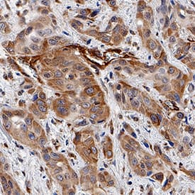 MLKL phosphorylated at T357 was detected in immersion fixed paraffin-embedded sections of human squamous cell carcinoma using Mouse Anti-Human Phospho-MLKL (T357) Monoclonal Antibody (Catalog # MAB9187) at 5 µg/mL for 1 hour at room temperature followed by incubation with the Anti-Mouse IgG VisUCyte™ HRP Polymer Antibody (Catalog # VC001). Tissue was stained using DAB (brown) and counterstained with hematoxylin (blue). Specific staining was localized to cytoplasm in cancer cells. View our protocol for IHC Staining with VisUCyte HRP Polymer Detection Reagents.