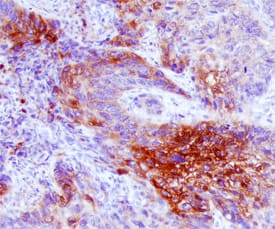 MMP-12 was detected in immersion fixed paraffin-embedded sections of human squamous cell carcinoma using Goat Anti-Human MMP-12 Antigen Affinity-purified Polyclonal Antibody (Catalog # AF917) at 10 µg/mL overnight at 4 °C. Before incubation with the primary antibody, tissue was subjected to heat-induced epitope retrieval using Antigen Retrieval Reagent-Basic (CTS013). Tissue was stained using the Anti-Goat HRP-DAB Cell & Tissue Staining Kit (brown; CTS008) and counterstained with hematoxylin (blue). Specific staining was localized to cancer cells. View our protocol for Chromogenic IHC Staining of Paraffin-embedded Tissue Sections.