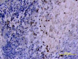 MMP-2 was detected in immersion fixed paraffin-embedded sections of human ovarian cancer tissue using Goat Anti-Human MMP-2 Antigen Affinity-purified Poly-clonal Antibody (Catalog # AF902) at 10 µg/mL overnight at 4 °C. Tissue was stained using the Anti-Goat HRP-DAB Cell & Tissue Staining Kit (brown; CTS008) and counter-stained with hematoxylin (blue). View our protocol for Chromogenic IHC Staining of Paraffin-embedded Tissue Sections.