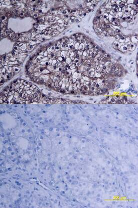 MMP-2 was detected in immersion fixed paraffin-embedded sections of human ovarian array using Goat Anti-Human MMP-2 Antigen Affinity-purified Polyclonal Antibody (Catalog # AF902) at 10 µg/mL overnight at 4 °C. Tissue was stained using the Anti-Goat HRP-DAB Cell & Tissue Staining Kit (brown; CTS008) and counterstained with hematoxylin (blue). Lower panel shows a lack of labeling if primary antibodies are omitted and tissue is stained only with secondary antibody followed by incubation with detection reagents. View our protocol for Chromogenic IHC Staining of Paraffin-embedded Tissue Sections.