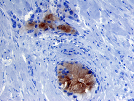 MMP-7 was detected in immersion fixed paraffin-embedded sections of human pancreatic cancer tissue using Human Pro-MMP-7 Monoclonal Antibody (Catalog # MAB907) at 10 µg/mL overnight at 4 °C. Before incubation with the primary antibody tissue was subjected to heat-induced epitope retrieval using Antigen Retrieval Reagent-Basic (Catalog # CTS013). Tissue was stained using the Anti-Mouse HRP-DAB Cell & Tissue Staining Kit (brown; Catalog # CTS002) and counterstained with hematoxylin (blue). View our protocol for Chromogenic IHC Staining of Paraffin-embedded Tissue Sections.