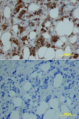 MMP-8 was detected in immersion fixed paraffin-embedded sections of human breast array using Goat Anti-Human MMP-8 Antigen Affinity-purified Polyclonal Antibody (Catalog # AF908) at 15 µg/mL overnight at 4 °C. Tissue was stained using the Anti-Goat HRP-DAB Cell & Tissue Staining Kit (brown; Catalog # CTS008) and counterstained with hematoxylin (blue). Lower panel shows a lack of labeling if primary antibodies are omitted and tissue is stained only with secondary antibody followed by incubation with detection reagents. View our protocol for Chromogenic IHC Staining of Paraffin-embedded Tissue Sections.