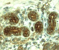 MMP-8 was detected in immersion fixed paraffin-embedded sections of human breast cancer tissue using 8 µg/mL Mouse Anti-Human MMP-8 Monoclonal Antibody (Catalog # MAB9081) overnight at 4 °C. Tissue was stained with the Anti-Mouse HRP-DAB Cell & Tissue Staining Kit (brown; CTS002) and counterstained with hematoxylin (blue). Specific labeling was localized to epithelial cells in terminal ductules (round) and intralobular duct (elongated) composing glandular lobules. View our protocol for Chromogenic IHC Staining of Paraffin-embedded Tissue Sections.