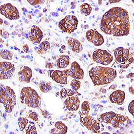 MMP-8 was detected in immersion fixed paraffin-embedded sections of human breast cancer tissue using Goat Anti-Human MMP-8 Biotinylated Antigen Affinity-purified Polyclonal Antibody (Catalog # BAF908) at 15 µg/mL overnight at 4 °C. Tissue was stained using the Anti-Goat HRP-DAB Cell & Tissue Staining Kit (brown; Catalog # CTS008) and counterstained with hematoxylin (blue). Specific staining was localized to cytoplasm in ductal cells. View our protocol for Chromogenic IHC Staining of Paraffin-embedded Tissue Sections.