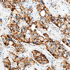 MMP-9 was detected in immersion fixed paraffin-embedded sections of human liver cancer tissue using Goat Anti-Human MMP-9 Polyclonal Antibody (Catalog # AB911) at 10 µg/mL overnight at 4 °C. Tissue was stained using the Anti-Goat HRP-DAB Cell & Tissue Staining Kit (brown; Catalog # CTS008) and counterstained with hematoxylin (blue). Specific staining was localized to cytoplasm in cancer cells. View our protocol for Chromogenic IHC Staining of Paraffin-embedded Tissue Sections.