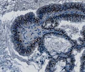 MSX1 was detected in immersion fixed paraffin-embedded sections of human ovarian cancer tissue using Goat Anti-Human/Mouse MSX1 Antigen Affinity-purified Polyclonal Antibody (Catalog # AF5045) at 0.3, 1.0 and 3.0 µg/mL overnight at 4 °C. Tissue was stained using the Anti-Goat HRP-DAB Cell & Tissue Staining Kit (brown; Catalog # CTS008) and counterstained with hematoxylin (blue). Specific staining was localized to nuclei. View our protocol for Chromogenic IHC Staining of Paraffin-embedded Tissue Sections.