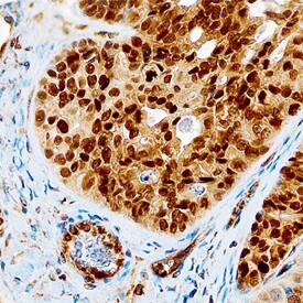 MSX1 was detected in immersion fixed paraffin-embedded sections of human ovary using Mouse Anti-Human MSX1 Monoclonal Antibody (Catalog # MAB5045) at 15 µg/mL overnight at 4 °C. Before incubation with the primary antibody, tissue was subjected to heat-induced epitope retrieval using Antigen Retrieval Reagent-Basic (Catalog # CTS013). Tissue was stained using the Anti-Mouse HRP-DAB Cell & Tissue Staining Kit (brown; Catalog # CTS002) and counter-stained with hematoxylin (blue). Specific staining was localized to nuclei. View our protocol for Chromogenic IHC Staining of Paraffin-embedded Tissue Sections.