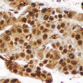 MUC-1 was detected in immersion fixed paraffin-embedded sections of human breast using Sheep Anti-Human MUC-1 Antigen Affinity-purified Polyclonal Antibody (Catalog # AF6298) at 10 µg/mL overnight at 4 °C. Tissue was stained using the Anti-Sheep HRP-DAB Cell & Tissue Staining Kit (brown; Catalog # CTS019) and counterstained with hematoxylin (blue). Specific staining was localized to nuclei and cytoplasm in epithelial cells. View our protocol for Chromogenic IHC Staining of Paraffin-embedded Tissue Sections.