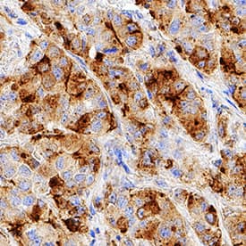MUC-1 was detected in immersion fixed paraffin-embedded sections of human breast cancer tissue using Rabbit Anti-Human MUC-1 Monoclonal Antibody (Catalog # MAB62981) at 3 µg/mL for 1 hour at room temperature followed by incubation with the Anti-Goat IgG VisUCyte™ HRP Polymer Antibody (VC004). Tissue was stained using DAB (brown) and counterstained with hematoxylin (blue). Specific staining was localized to cytoplasm. View our protocol for IHC Staining with VisUCyte HRP Polymer Detection Reagents.
