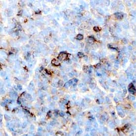 Mcl-1 was detected in immersion fixed paraffin-embedded sections of human lymphoma using Mouse Anti-Human Mcl-1 Monoclonal Antibody (Catalog # MAB8281) at 15 µg/mL overnight at 4 °C. Before incubation with the primary antibody, tissue was subjected to heat-induced epitope retrieval using Antigen Retrieval Reagent-Basic (Catalog # CTS013). Tissue was stained using the Anti-Mouse HRP-DAB Cell & Tissue Staining Kit (brown; Catalog # CTS002) and counter-stained with hematoxylin (blue). Specific staining was localized to the cytoplasm and plasma membranes of lymphocytes. View our protocol for Chromogenic IHC Staining of Paraffin-embedded Tissue Sections.
