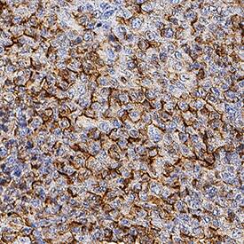 Melanotransferrin/CD228 was detected in perfusion fixed frozen sections of human melanoma tissue using Mouse Anti-Human Melanotransferrin/CD228 Monoclonal Antibody (Catalog # MAB8175) at 5 µg/mL for 1 hour at room temperature followed by incubation with the Anti-Mouse IgG VisUCyte™ HRP Polymer Antibody (Catalog # VC001). Tissue was stained using DAB (brown) and counterstained with hematoxylin (blue). Specific staining was localized to plasma membrane and cytoplasm. View our protocol for IHC Staining with VisUCyte HRP Polymer Detection Reagents.