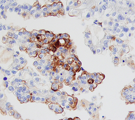Mesothelin was detected in immersion fixed paraffin-embedded sections of human ovarian cancer tissue using 5 µg/mL Rat Anti-Human Mesothelin Monoclonal Antibody (Catalog # MAB32651) overnight at 4 °C. Before incubation with the primary antibody tissue was subjected to heat-induced epitope retrieval using Antigen Retrieval Reagent-Basic (Catalog # CTS013). Tissue was stained with the Anti-Rat HRP-DAB Cell & Tissue Staining Kit (brown; Catalog # CTS017) and counterstained with hematoxylin (blue). View our protocol for Chromogenic IHC Staining of Paraffin-embedded Tissue Sections.
