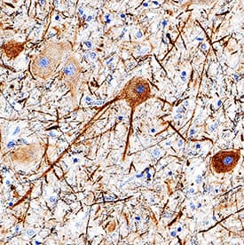 NF-L was detected in immersion fixed paraffin-embedded sections of human brain (substantia nigra) using Mouse Anti-Human NF-L Monoclonal Antibody (Catalog # MAB22161) at 5 µg/mL for 1 hour at room temperature followed by incubation with the Anti-Mouse IgG VisUCyte™ HRP Polymer Antibody (Catalog # VC001). Tissue was stained using DAB (brown) and counterstained with hematoxylin (blue). Specific staining was localized to neurons. View our protocol for IHC Staining with VisUCyte HRP Polymer Detection Reagents.
