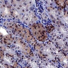 NLRP1/NALP1 was detected in immersion fixed paraffin-embedded sections of human stomach cancer tissue using Mouse Anti-Human NLRP1/NALP1 Monoclonal Antibody (Catalog # MAB6788) at 0.5 µg/mL for 1 hour at room temperature followed by incubation with the Anti-Mouse IgG VisUCyte™ HRP Polymer Antibody (Catalog # VC001). Before incubation with the primary antibody, tissue was subjected to heat-induced epitope retrieval using Antigen Retrieval Reagent-Basic (Catalog # CTS013). Tissue was stained using DAB (brown) and counterstained with hematoxylin (blue). Specific staining was localized to nuclei. View our protocol for IHC Staining with VisUCyte HRP Polymer Detection Reagents.