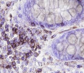 Neuromedin B R/NMBR was detected in immersion fixed paraffin-embedded sections of human colon cancer tissue using Human Neuromedin B R/NMBR Monoclonal Antibody (Catalog # MAB47281) at 15 µg/mL overnight at 4 °C. Before incubation with the primary antibody, tissue was subjected to heat-induced epitope retrieval using Antigen Retrieval Reagent-Basic (Catalog # CTS013). Tissue was stained using the Anti-Mouse HRP-DAB Cell & Tissue Staining Kit (brown; Catalog # CTS002) and counterstained with hematoxylin (blue). Specific staining was localized to plasma membranes. View our protocol for Chromogenic IHC Staining of Paraffin-embedded Tissue Sections.