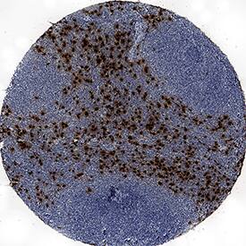 Neutrophil Elastase/ELA2 was detected in immersion fixed paraffin-embedded sections of human lymphoma using Mouse Anti-Human Neutrophil Elastase/ELA2 Monoclonal Antibody (Catalog # MAB91672) at 5 µg/mL overnight at 4 °C. Tissue was stained using the Anti-Mouse IgG VisUCyte™ HRP Polymer Antibody (brown; Catalog # VC001) and counterstained with hematoxylin (blue). Specific staining was localized to cytoplasm of cancer cells. View our protocol for IHC Staining with VisUCyte HRP Polymer Detection Reagents.