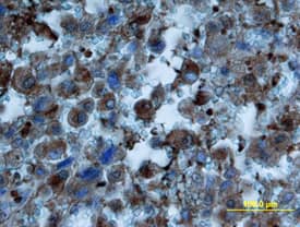 Osteocalcin was detected in immersion fixed paraffin-embedded sections of human osteosarcoma using Mouse Anti-Human/Rat Osteocalcin Monoclonal Antibody (Catalog # MAB1419) at 25 µg/mL overnight at 4 °C. Tissue was stained using the Anti-Mouse HRP-DAB Cell & Tissue Staining Kit (brown; Catalog # CTS002) and counterstained with hematoxylin (blue). View our protocol for Chromogenic IHC Staining of Paraffin-embedded Tissue Sections.