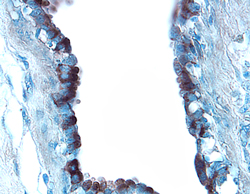 Osteopontin/OPN was detected in immersion fixed paraffin-embedded sections of human breast cancer tissue using 8 µg/mL Goat Anti-Human Osteopontin/OPN Antigen Affinity-purified Polyclonal Antibody (Catalog # AF1433) overnight at 4 °C. Tissue was stained with the Anti-Goat HRP-DAB Cell & Tissue Staining Kit (brown; Catalog # CTS008) and counterstained with hematoxylin (blue). Specific labeling was localized to the surface of epithelial cells in the intralobular duct. View our protocol for Chromogenic IHC Staining of Paraffin-embedded Tissue Sections.