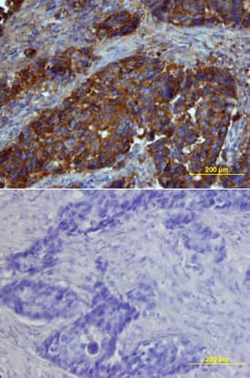 Osteopontin/OPN was detected in immersion fixed paraffin-embedded sections of human breast cancer tissue using Goat Anti-Human Osteopontin/OPN Antigen Affinity-purified Polyclonal Antibody (Catalog # AF1433) at 15 µg/mL overnight at 4 °C. Tissue was stained using the Anti-Goat HRP-DAB Cell & Tissue Staining Kit (brown; Catalog # CTS008) and counterstained with hematoxylin (blue). Lower panel shows a lack of labeling if primary antibodies are omitted and tissue is stained only with secondary antibody followed by incubation with detection reagents. View our protocol for Chromogenic IHC Staining of Paraffin-embedded Tissue Sections.