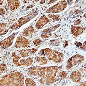 Osteopontin/OPN was detected in immersion fixed paraffin-embedded sections of human breast cancer tissue using Mouse Anti-Human Osteopontin/OPN Monoclonal Antibody (Catalog # MAB1433) at 25 µg/mL overnight at 4 °C. Tissue was stained using the Anti-Mouse HRP-DAB Cell & Tissue Staining Kit (brown; Catalog # CTS002) and counterstained with hematoxylin (blue). Specific staining was localized to cytoplasm in epithelial cells. View our protocol for Chromogenic IHC Staining of Paraffin-embedded Tissue Sections.