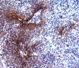P-Selectin/CD62P was detected in immersion fixed paraffin-embedded sections of human breast cancer tissue using 25 µg/mL Human P-Selectin/CD62P Monoclonal Antibody (Catalog # BBA30) overnight at 4 °C. Tissue was stained with the Anti-Mouse HRP-DAB Cell & Tissue Staining Kit (brown; Catalog # CTS002) and counterstained with hematoxylin (blue). View our protocol for Chromogenic IHC Staining of Paraffin-embedded Tissue Sections.