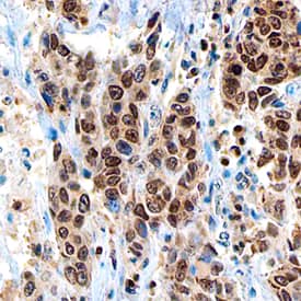 PARP was detected in immersion fixed paraffin-embedded sections of human breast using Mouse Anti-Human PARP Monoclonal Antibody (Catalog # MAB8095) at 15 µg/mL overnight at 4 °C. Before incubation with the primary antibody, tissue was subjected to heat-induced epitope retrieval using Antigen Retrieval Reagent-Basic (Catalog # CTS013). Tissue was stained using the Anti-Mouse HRP-DAB Cell & Tissue Staining Kit (brown; Catalog # CTS002) and counterstained with hematoxylin (blue). Specific staining was localized to the nuclei of epithelial cells. View our protocol for Chromogenic IHC Staining of Paraffin-embedded Tissue Sections.