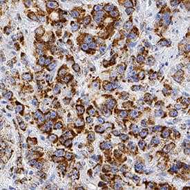 PBR was detected in immersion fixed paraffin-embedded sections of human prostate cancer tissue using Rabbit Anti-Human PBR Monoclonal Antibody (Catalog # MAB10045) at 3 µg/mL for 1 hour at room temperature followed by incubation with the Anti-Rabbit IgG VisUCyte™ HRP Polymer Antibody (Catalog # VC003). Before incubation with the primary antibody, tissue was subjected to heat-induced epitope retrieval using Antigen Retrieval Reagent-Basic (Catalog # CTS013). Tissue was stained using DAB (brown) and counterstained with hematoxylin (blue). Specific staining was localized to cytoplasm (mitochondria) in cancer cells. View our protocol for IHC Staining with VisUCyte HRP Polymer Detection Reagents.