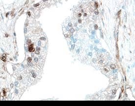 PD-ECGF/Thymidine Phosphorylase was detected in immersion fixed paraffin-embedded sections of human prostate cancer tissue using 5 µg/mL Goat Anti-Human PD-ECGF/Thymidine Phosphorylase Antigen Affinity-purified Polyclonal Antibody (Catalog # AF1143) overnight at 4 °C. Tissue was stained with the Anti-Goat HRP-DAB Cell & Tissue Staining Kit (brown; Catalog # CTS008) and counter-stained with hematoxylin (blue). View our protocol for Chromogenic IHC Staining of Paraffin-embedded Tissue Sections.