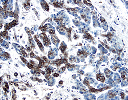 PDGF‑C was detected in immersion fixed paraffin-embedded sections of human pancreatic cancer tissue using 1.7 &micro;g/mL Goat Anti-Human PDGF‑C Antigen Affinity-purified Polyclonal Antibody (Catalog # AF1560) overnight at 4 &deg;C. Tissue was stained with the Anti-Goat HRP-DAB Cell & Tissue Staining Kit (brown; Catalog # CTS008) and counterstained with hematoxylin (blue). View our protocol for Chromogenic IHC Staining of Paraffin-embedded Tissue Sections.