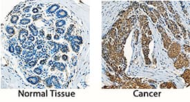 PDGF-AA was detected in immersion fixed paraffin-embedded sections of human breast and breast cancer tissue using Goat Anti-Human PDGF-AA Antigen Affinity-purified Polyclonal Antibody (Catalog # AF-221-NA) at 5 µg/mL overnight at 4 °C. Tissue was stained using the Anti-Goat HRP-DAB Cell & Tissue Staining Kit (brown; Catalog # CTS008) and counterstained with hematoxylin (blue). Specific staining was localized to epithelial cells. View our protocol for Chromogenic IHC Staining of Paraffin-embedded Tissue Sections.