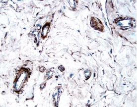 PDGF R beta  was detected in immersion fixed paraffin-embedded sections of human breast cancer tissue using 15 µg/mL Goat Anti-Human PDGF R beta  Antigen Affinity-purified Polyclonal Antibody (Catalog # AF385) overnight at 4 °C. Tissue was stained with the Anti-Goat HRP-DAB Cell & Tissue Staining Kit (brown; CTS008) and counterstained with hematoxylin (blue). View our protocol for Chromogenic IHC Staining of Paraffin-embedded Tissue Sections.