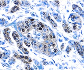 PDX-1/IPF1 was detected in immersion fixed paraffin-embedded sections of human pancreatic cancer tissue using Goat Anti-Human PDX-1/IPF1 Antigen Affinity-purified Polyclonal Antibody (Catalog # AF2419) at 15 µg/mL overnight at 4 °C. Tissue was stained using the Anti-Goat HRP-DAB Cell & Tissue Staining Kit (brown; Catalog # CTS008) and counterstained with hematoxylin (blue). Specific staining was localized to nuclei in cancer cells. View our protocol for Chromogenic IHC Staining of Paraffin-embedded Tissue Sections.