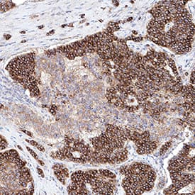 PKA RIIa was detected in immersion fixed paraffin-embedded sections of human pancreatic cancer tissue using Rabbit Anti-Human/Mouse PKA RIIa Monoclonal Antibody (Catalog # MAB8000) at 0.3 µg/mL for 1 hour at room temperature followed by incubation with the Anti-Rabbit IgG VisUCyte™ HRP Polymer Antibody (Catalog # VC003). Before incubation with the primary antibody, tissue was subjected to heat-induced epitope retrieval using Antigen Retrieval Reagent-Basic (Catalog # CTS013). Tissue was stained using DAB (brown) and counterstained with hematoxylin (blue). Specific staining was localized to cytoplasm in cancer cells. View our protocol for IHC Staining with VisUCyte HRP Polymer Detection Reagents.