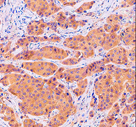 PKCa was detected in immersion fixed paraffin-embedded sections of human breast cancer tissue using Goat Anti-Human/Mouse/Rat PKCa Antigen Affinity-purified Polyclonal Antibody (Catalog # AF5340) at 10 µg/mL overnight at 4 °C. Tissue was stained using the Anti-Goat HRP-DAB Cell & Tissue Staining Kit (brown; Catalog # CTS008) and counterstained with hematoxylin (blue). Specific staining was localized to cancer cell cytoplasm. View our protocol for Chromogenic IHC Staining of Paraffin-embedded Tissue Sections.