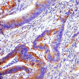 PLD2 was detected in immersion fixed paraffin-embedded sections of human colon cancer tissue using Goat Anti-Human PLD2 Antigen Affinity-purified Polyclonal Antibody (Catalog # AF10123) at 10 µg/mL for 1 hour at room temperature followed by incubation with the Anti-Goat IgG VisUCyte™ HRP Polymer Antibody (Catalog # VC004). Before incubation with the primary antibody, tissue was subjected to heat-induced epitope retrieval using Antigen Retrieval Reagent-Basic (Catalog # CTS013). Tissue was stained using DAB (brown) and counterstained with hematoxylin (blue). Specific staining was localized to cytoplasm in epithelial cells. View our protocol for IHC Staining with VisUCyte HRP Polymer Detection Reagents.